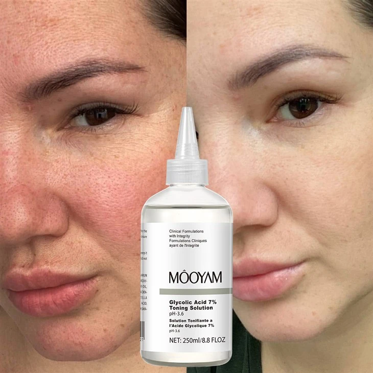 Mooyam 7% esfoliando o toner glicólico refinando poros